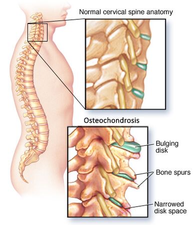 emakakaela osteokondroos
