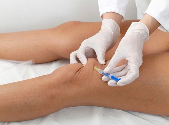 põlveliigese artroosi intraartikulaarne süstimine