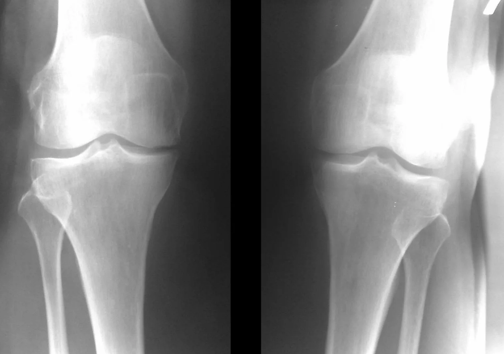 põlveliigese artroosi diagnoosimine