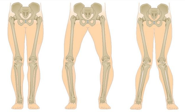 põlveliigese artroosi tüsistused